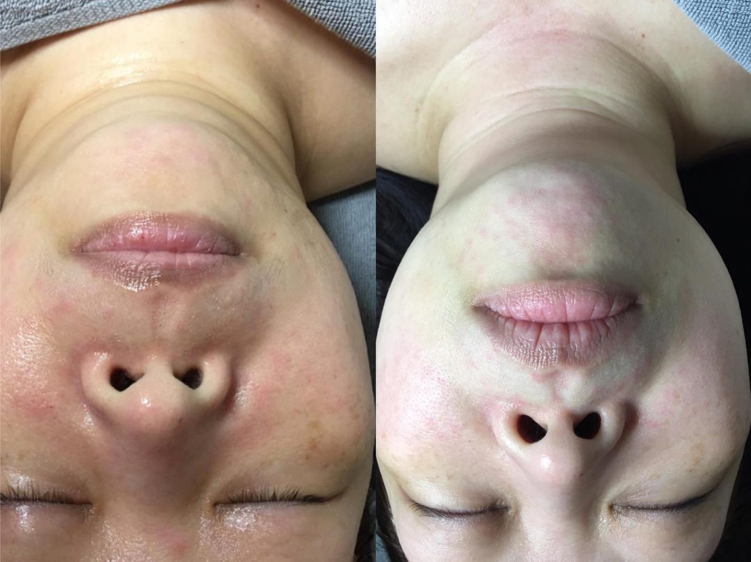 double chin lifting anti aging